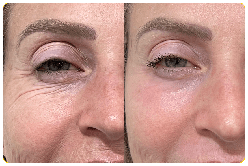 Resultado 2 - Redução de rugas ao redor dos olhos